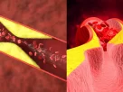 Blood Clotting