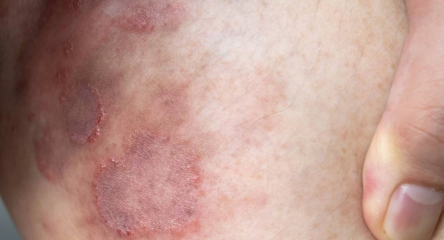 Ringworm treatment