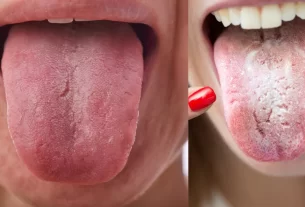 Tongue Health