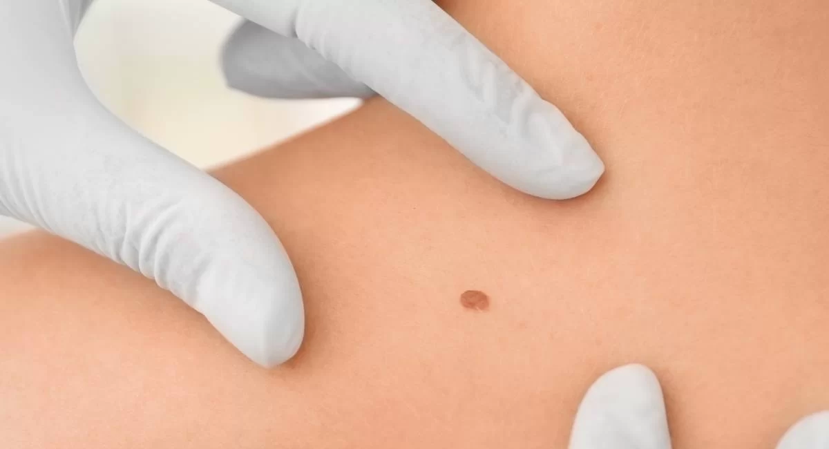 Private Part Mole Meaning