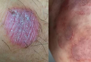 Ringworm treatment