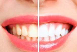 Teeth Whitening