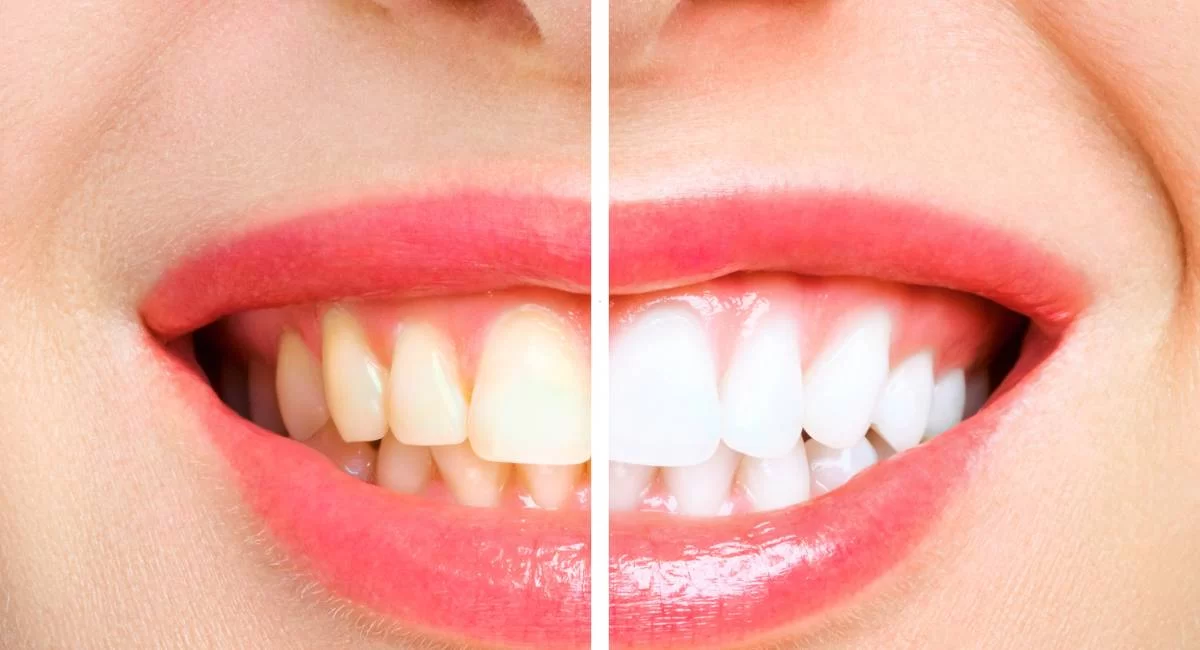Teeth Whitening