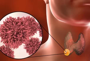 Thyroid Cancer