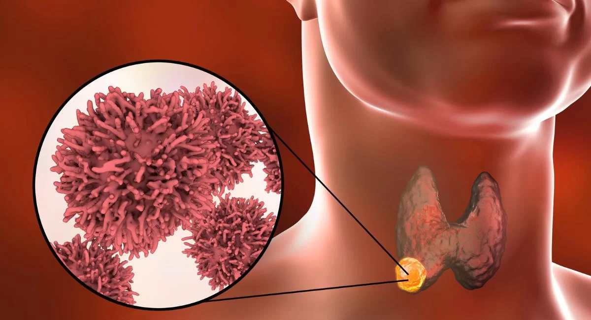 Thyroid Cancer