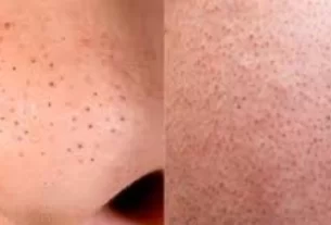 Blackheads