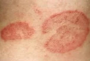 Ringworm Treatment