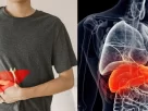 iron overload disease